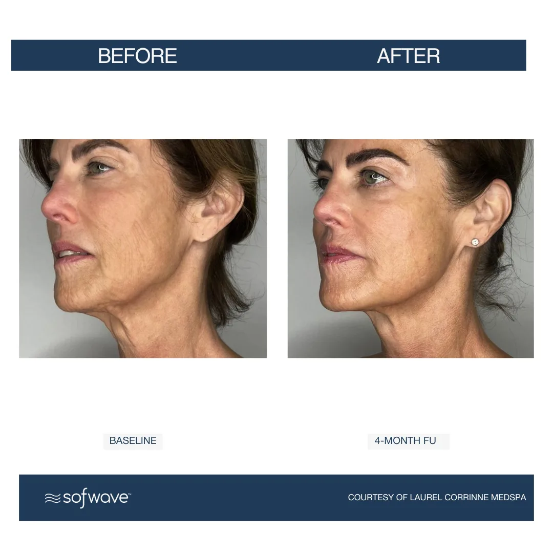 Sofwave™ Face & Neck Renewal treatment at RevitaGlow